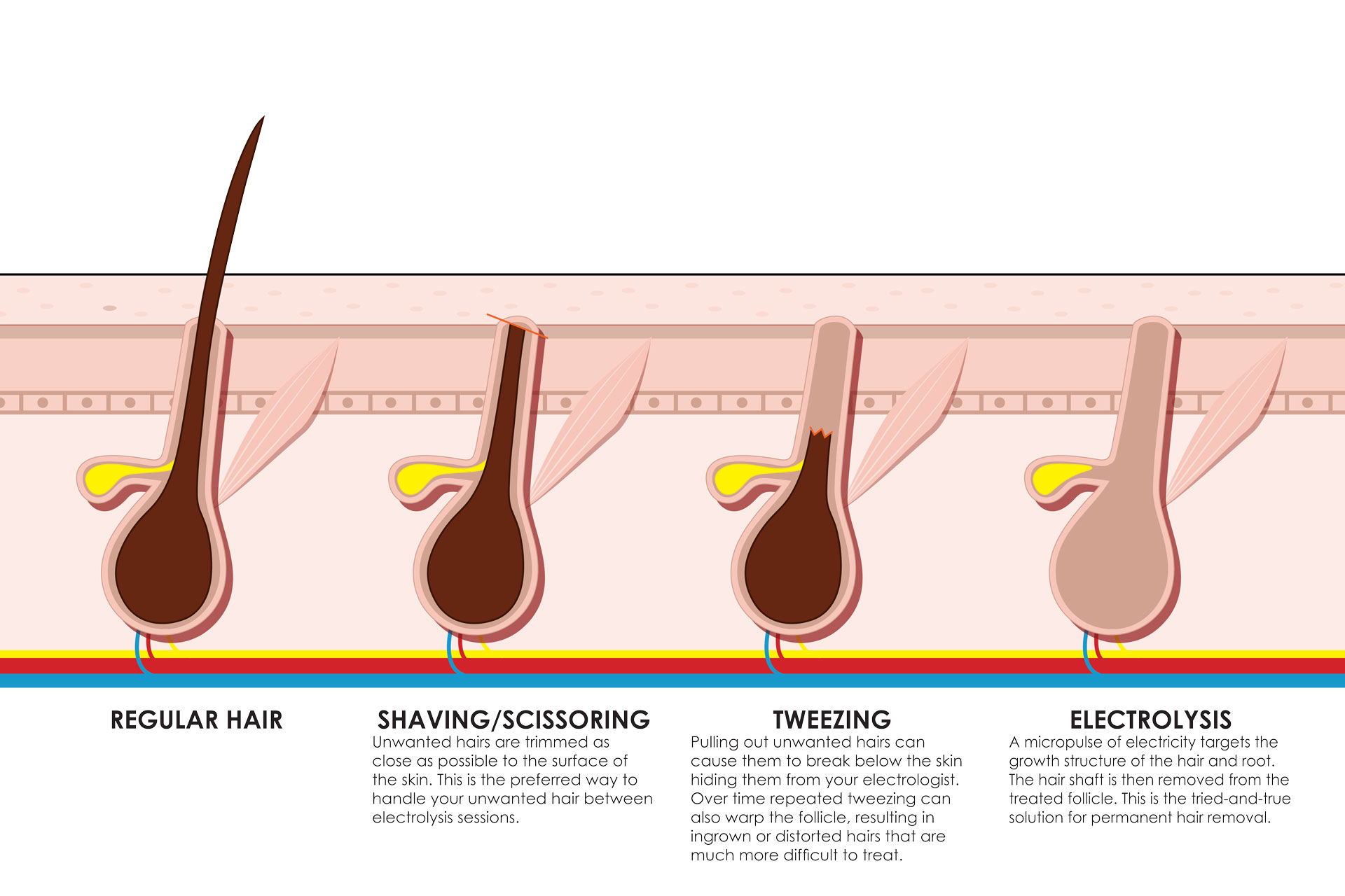 Unlike other hair removal methods, electrolysis breaksdown the cells responsible for hair growth, making it truly permanent hair removal