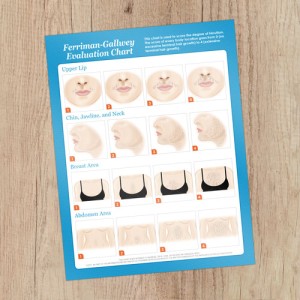 Hirsutism Chart  8.5x11 Consultation Card - Rated PG-13